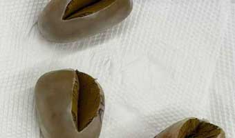 পায়ুপথে সোনার ডিম
